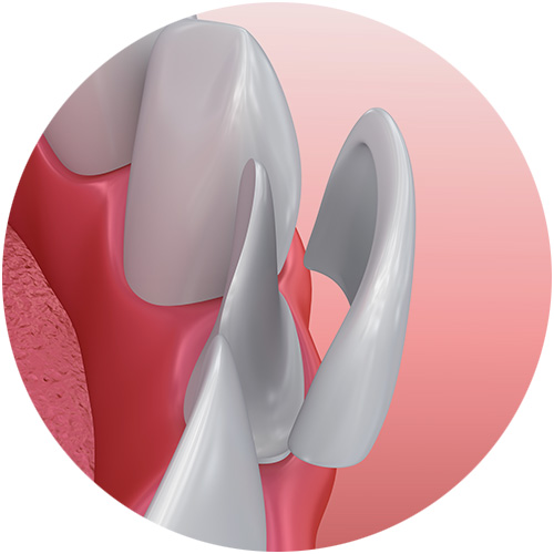 Veneers Veneers
