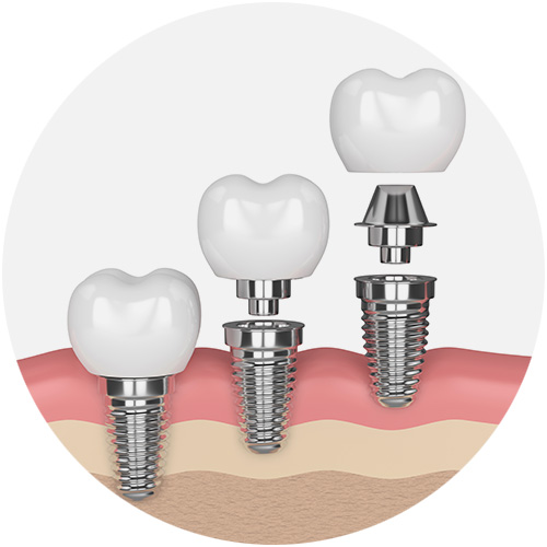 Dental Implant