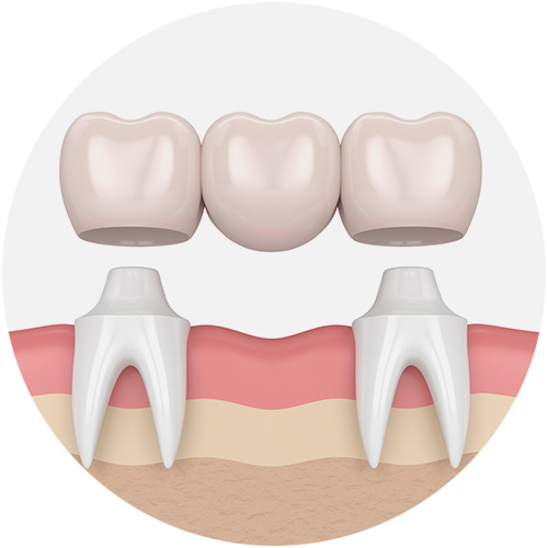 Dental Bridges