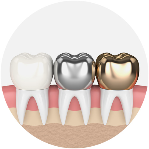 Dental Crowns