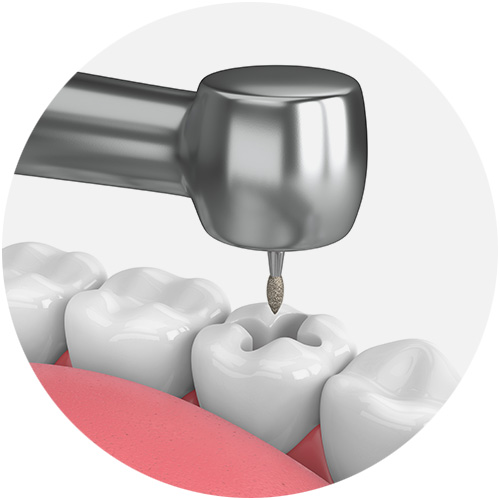 Restorative Dental (Fillings)