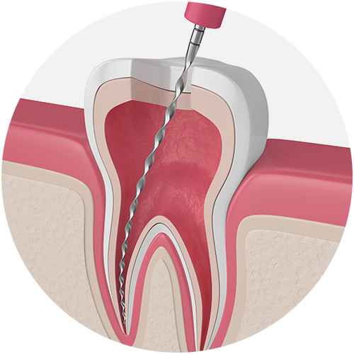 Root Canal Treatment